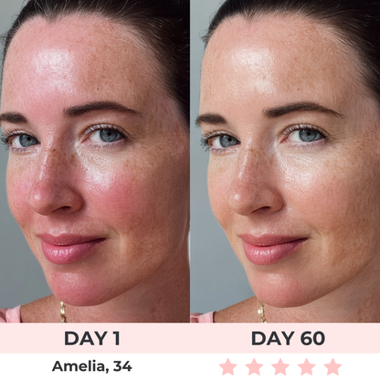 DermLite™ - LED Face Mask